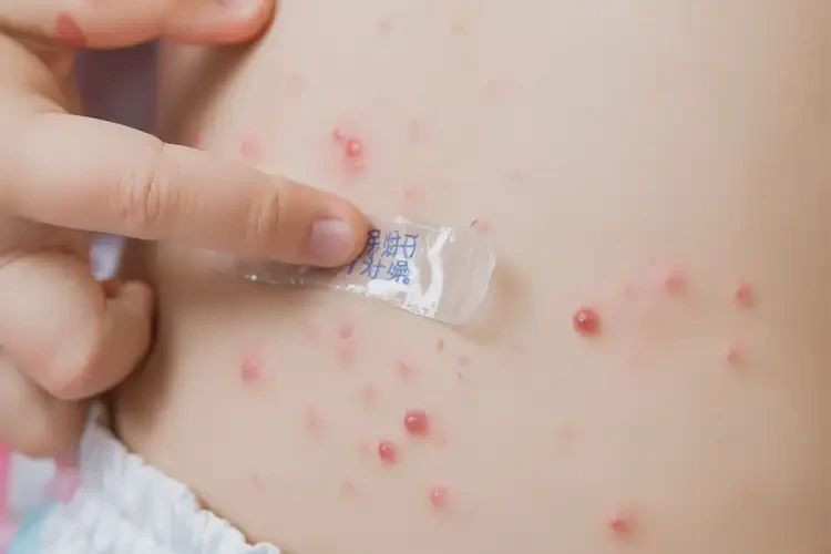 小孩肛周長(zhǎng)濕疹不管它會(huì)自己好嗎(圖3)