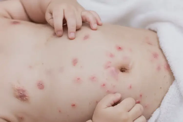 寶寶肚子容易長濕疹不管它會自己好嗎(圖4)