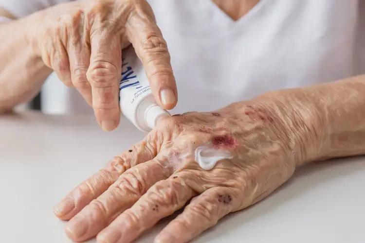 老年人手上出現(xiàn)濕疹可以徹底自愈嗎(圖3)