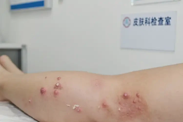 青少年小腿有濕疹能靠自己自愈嗎(圖3)