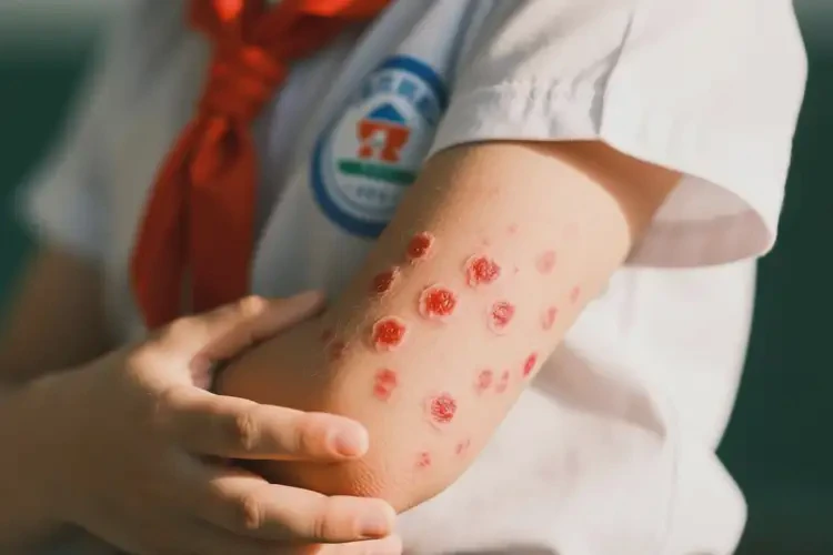 小學(xué)生手臂上容易起濕疹可以徹底自愈嗎(圖4)