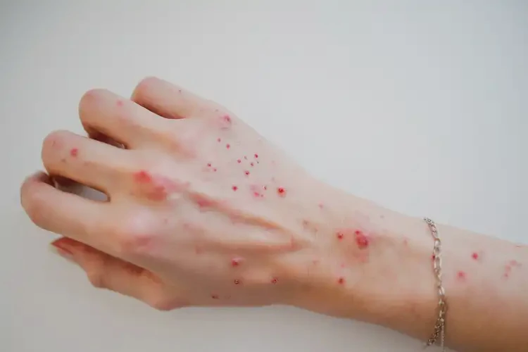 女生手上起濕疹不管它會自己痊愈嗎(圖4)