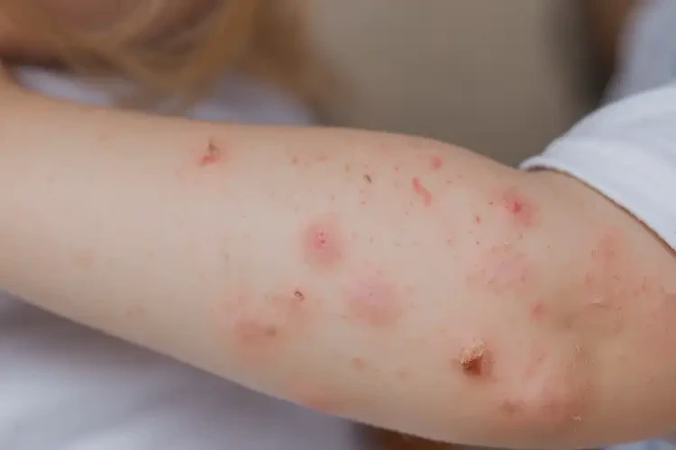 少兒手臂出濕疹不管它會(huì)自己痊愈嗎(圖4)