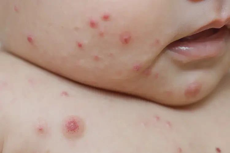 寶寶屁股經(jīng)常起濕疹能夠徹底治愈嗎(圖4)