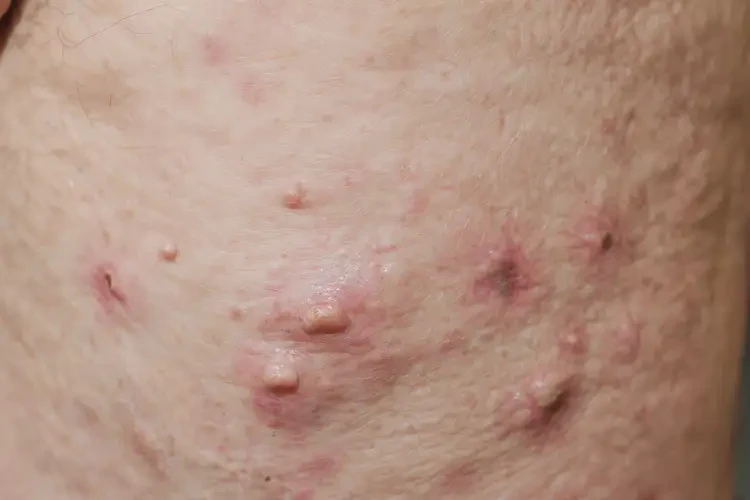 男人肛周長濕疹可以徹底自愈嗎(圖4)