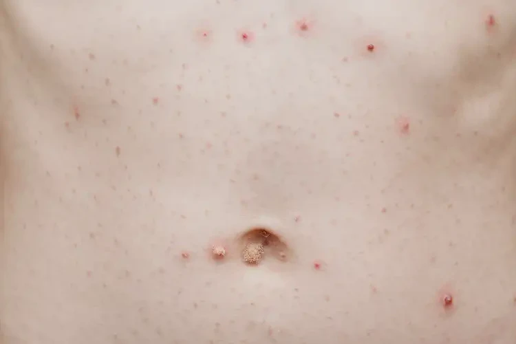 青少年肚子上出現(xiàn)濕疹不管它會自己好嗎(圖4)