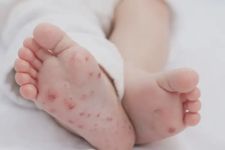 幼兒腳上長濕疹能夠徹底治愈嗎(圖4)