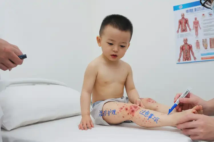 幼兒小腿上容易起濕疹不管它會(huì)自己自愈嗎(圖4)