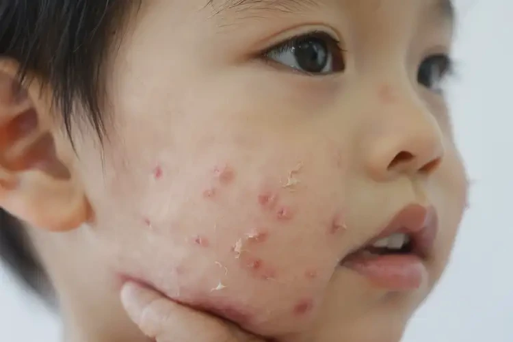 兒童臉上有濕疹不管它會自己好嗎(圖4)