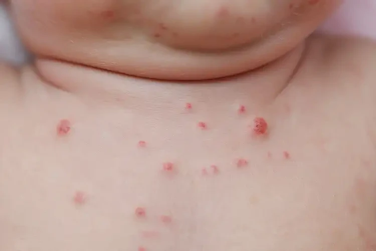 新生兒脖子偶爾長(zhǎng)濕疹能徹底自愈嗎(圖4)