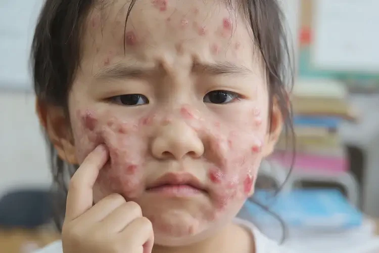 小學(xué)生臉上長濕疹能徹底自愈嗎(圖4)