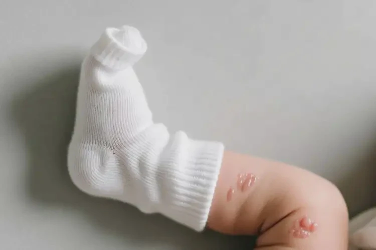 新生兒腳上偶爾起濕疹可不可以徹底自愈(圖2)