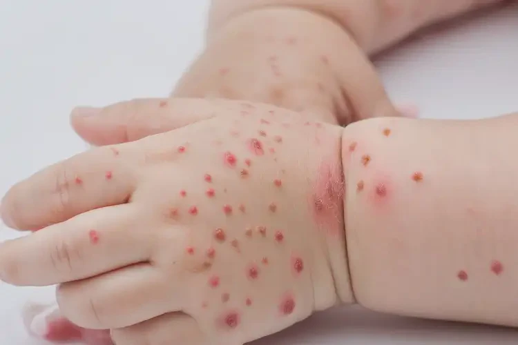 少兒脖子容易起濕疹不管它會自己好嗎(圖4)