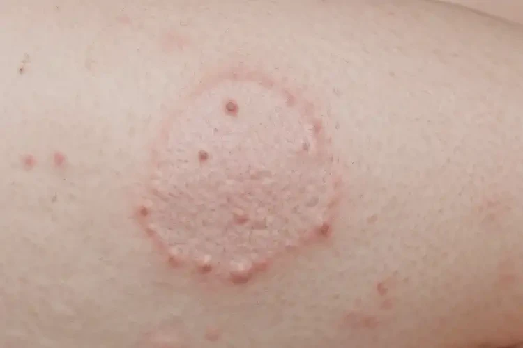 青少年大腿上偶爾起濕疹能靠自己自愈嗎(圖4)