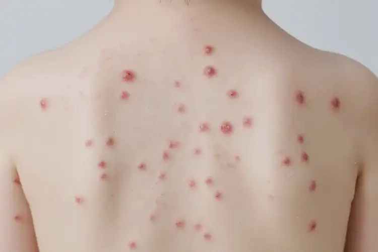 少兒屁股起濕疹不管它會(huì)自己自愈嗎(圖4)