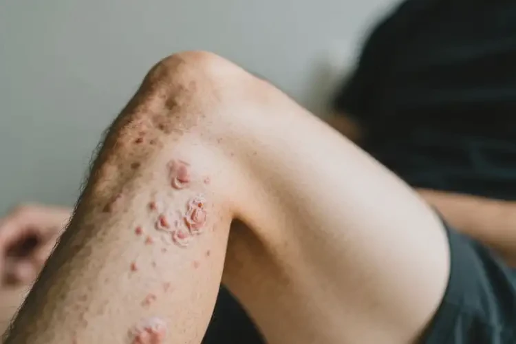 男生大腿上容易长湿疹不管它会自己痊愈吗(图3)