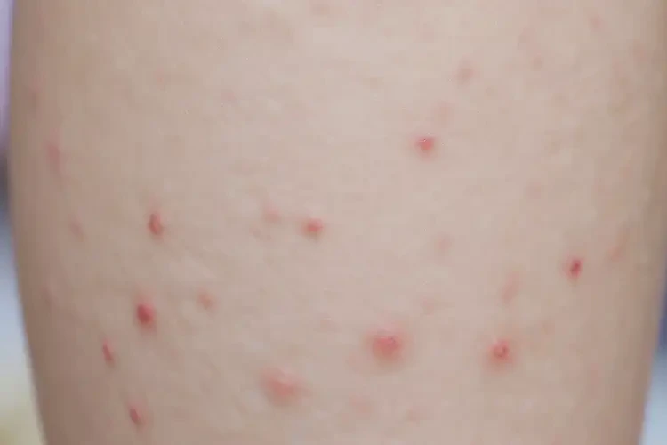 孩子大腿起濕疹可以徹底自愈嗎(圖4)