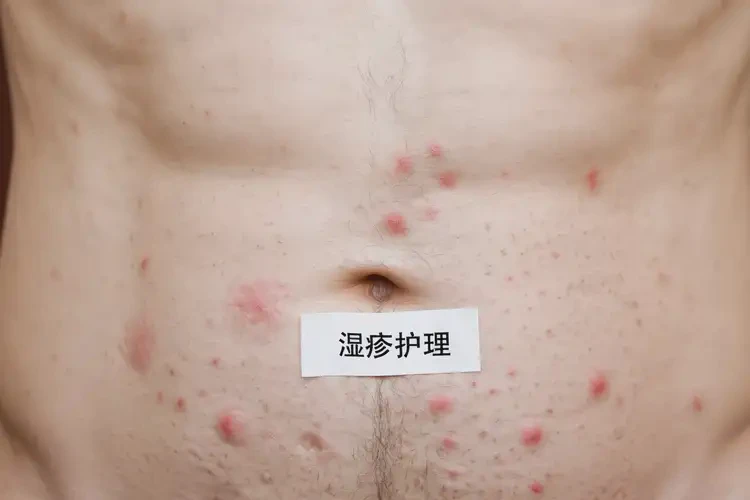 老年人肚子上起濕疹不管它會(huì)自己痊愈嗎(圖4)