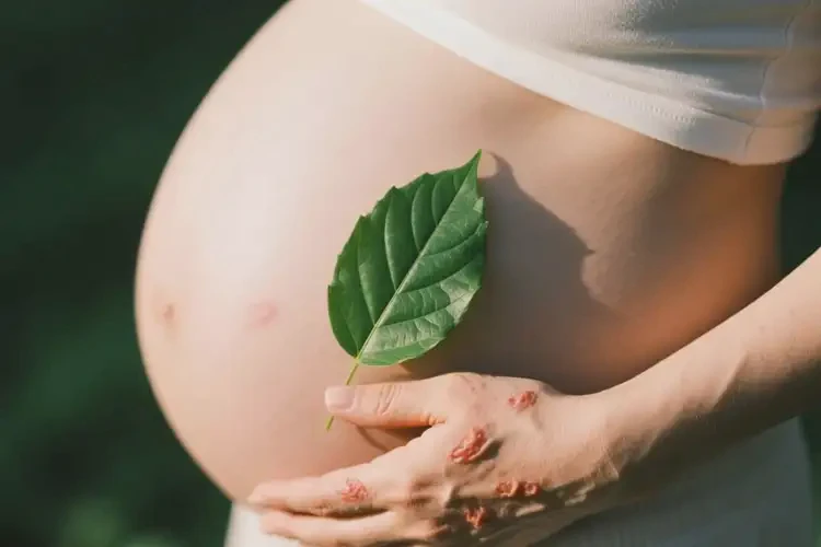 產(chǎn)婦手臂偶爾起濕疹不管它會自己痊愈嗎(圖2)