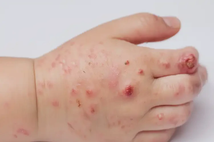 少兒手上經(jīng)常長濕疹不管它會自己痊愈嗎(圖4)