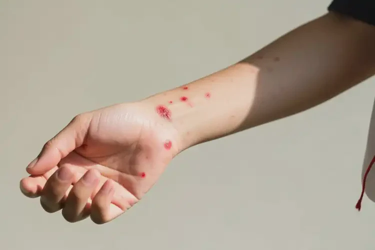 中學(xué)生手臂上出濕疹不管它會自己痊愈嗎(圖1)