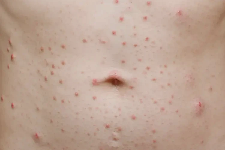 青少年肚子上偶爾起濕疹能不能徹底自愈(圖4)