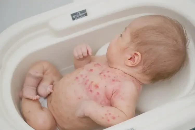 新生兒脖子長(zhǎng)濕疹不管它會(huì)自己自愈嗎(圖2)