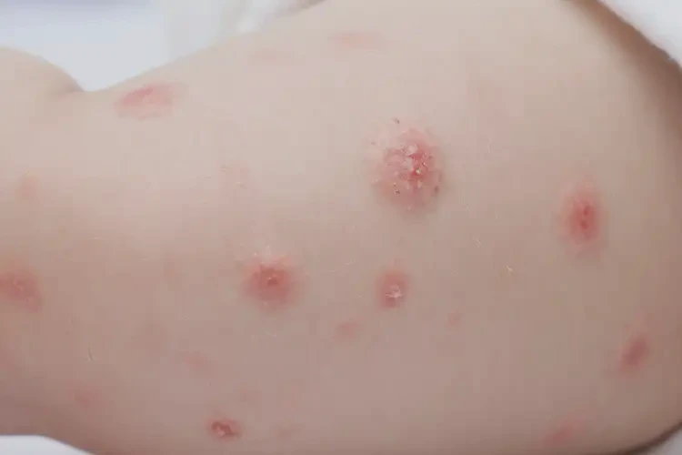 寶寶大腿上出濕疹不管它會(huì)自己痊愈嗎(圖4)