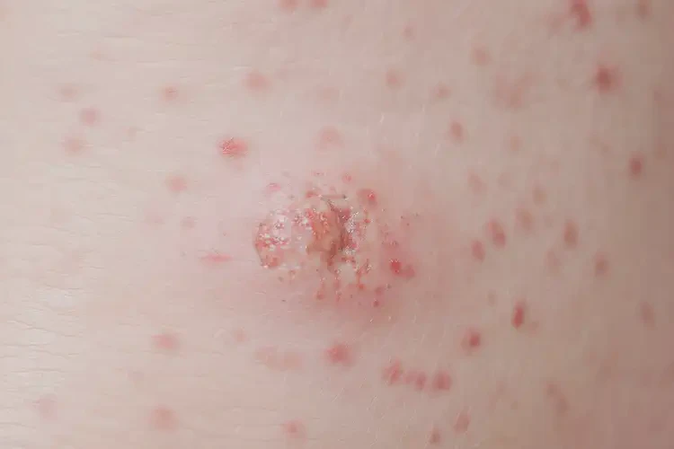 新生儿屁股容易起湿疹不管它会自己好吗(图4)