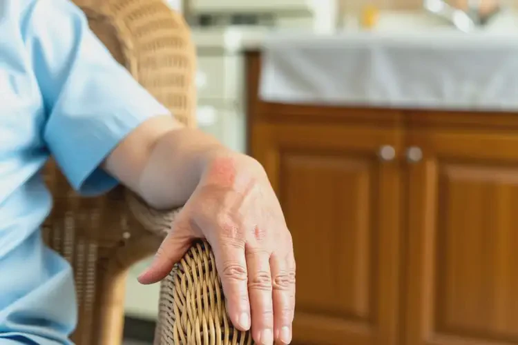 高齡老人手臂上偶爾起濕疹可以徹底自愈嗎(圖3)
