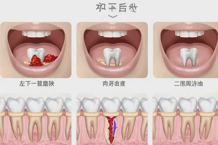 拔牙后可以吃指橙嗎(圖4)