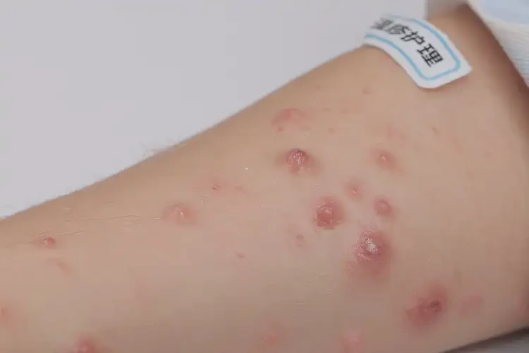 小學(xué)生手臂上起濕疹可不可以徹底自愈(圖4)