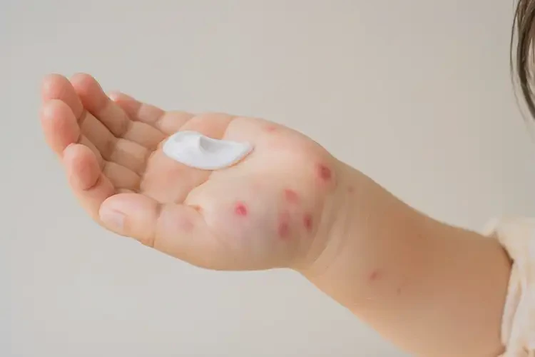 孩子手上容易起濕疹不管它會(huì)自己痊愈嗎(圖1)