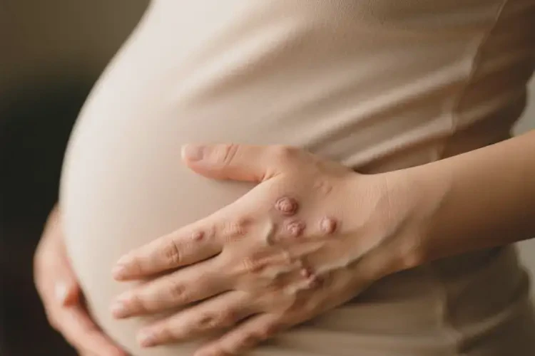 孕婦手上出濕疹能徹底自愈嗎(圖3)