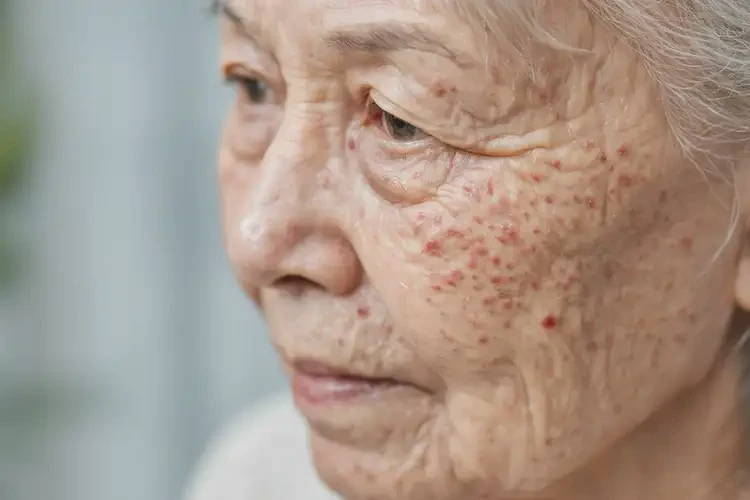 老年人四肢偶爾起濕疹不管它會自己自愈嗎(圖4)