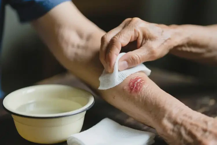 高齡老人手臂容易長濕疹不管它會自己好嗎(圖2)