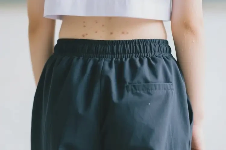 中學(xué)生屁股上偶爾起濕疹不管它會(huì)自己自愈嗎(圖4)