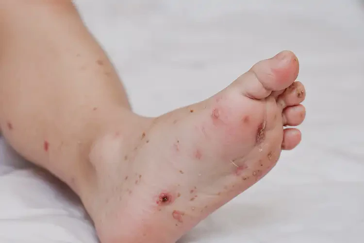 幼兒腳上經(jīng)常起濕疹能夠徹底治愈嗎(圖4)