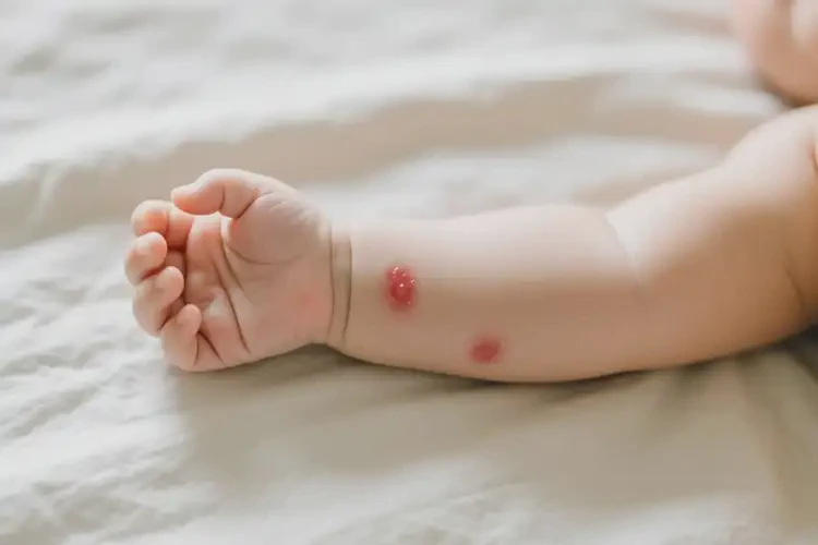 嬰兒手臂偶爾長(zhǎng)濕疹能夠徹底治愈嗎(圖2)