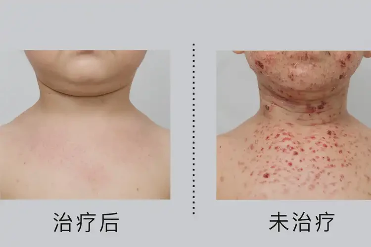 小儿脖子出现湿疹能靠自己自愈吗(图2)