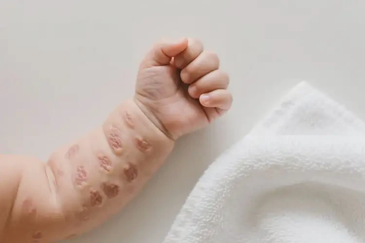 嬰幼兒手臂有濕疹不管它會(huì)自己自愈嗎(圖2)