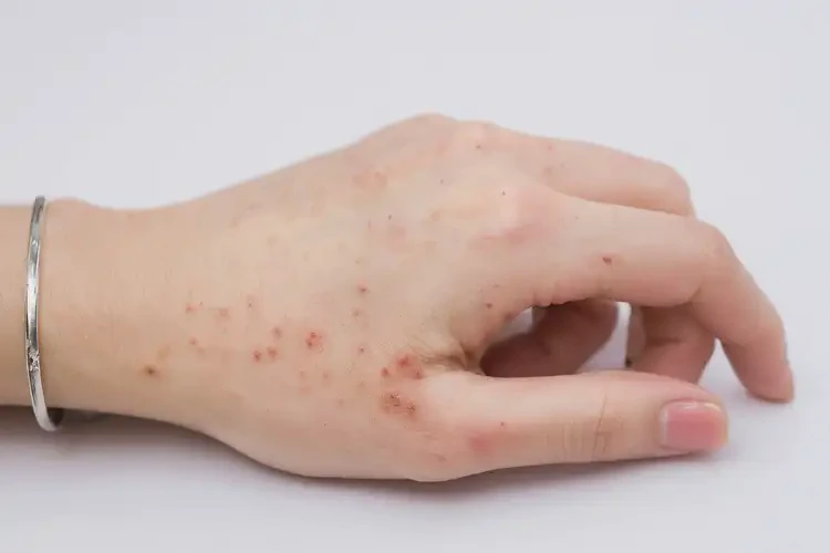 女生手上起濕疹不管它會自己痊愈嗎(圖3)