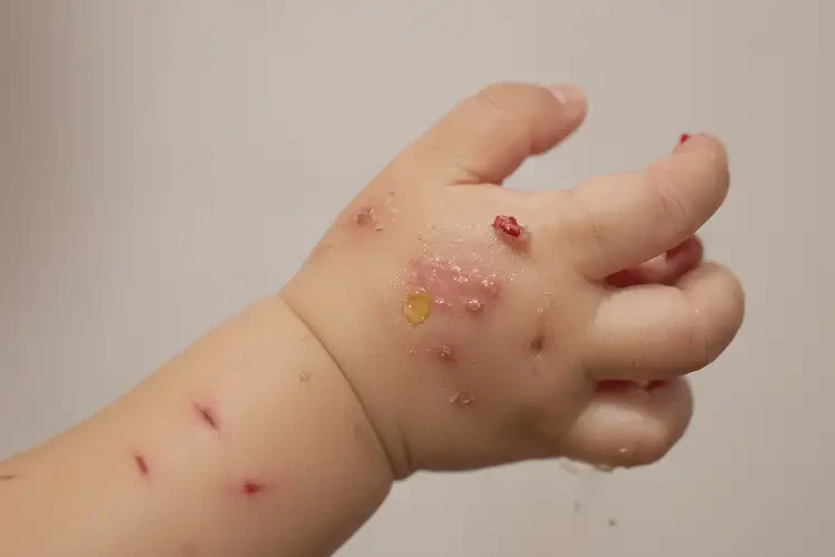 孩子手上容易起濕疹不管它會(huì)自己痊愈嗎(圖3)