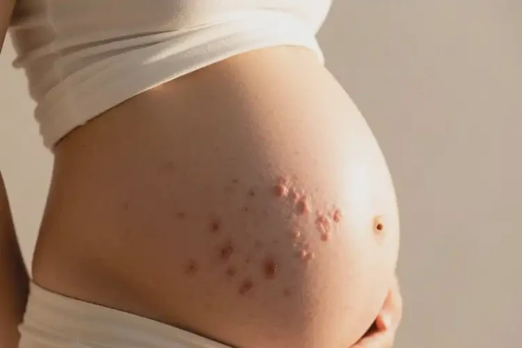 孕婦肚子上偶爾長(zhǎng)濕疹能夠徹底治愈嗎(圖2)
