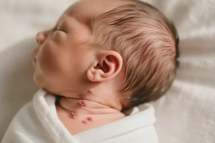 新生兒脖子偶爾起濕疹能夠徹底治愈嗎(圖2)