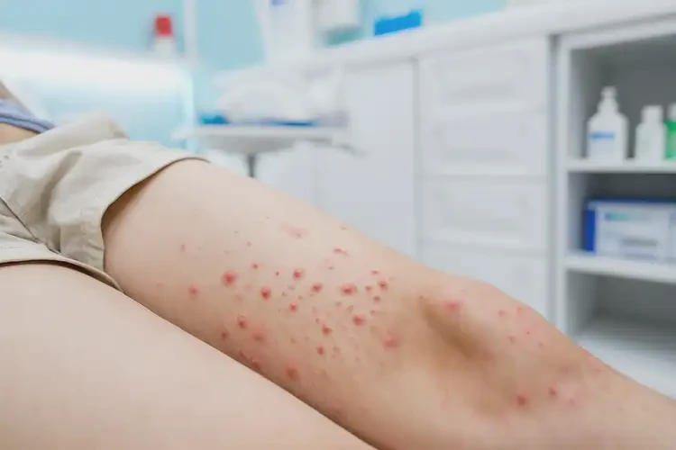 小孩大腿偶爾長(zhǎng)濕疹不管它會(huì)自己痊愈嗎(圖4)