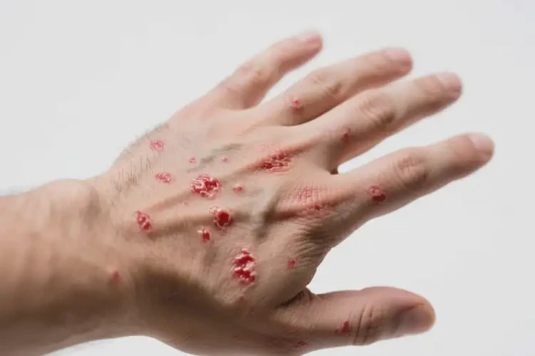 男性手上偶爾長(zhǎng)濕疹不管它會(huì)自己好嗎(圖4)