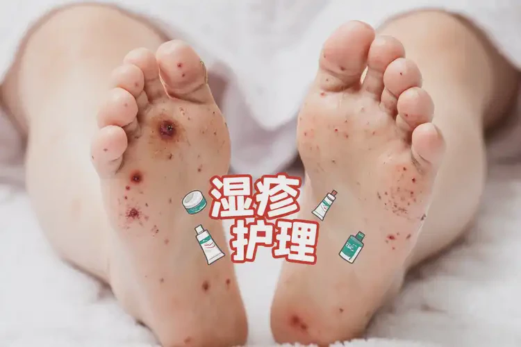 兒童腳上容易起濕疹不管它會(huì)自己自愈嗎(圖4)