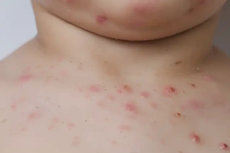 小孩脖子出現(xiàn)濕疹能夠徹底治愈嗎(圖4)