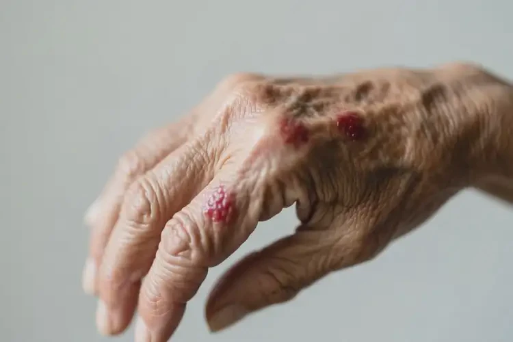 老人手上有濕疹不管它會(huì)自己好嗎(圖2)